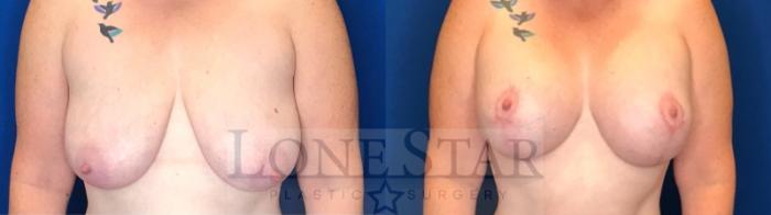 Before & After Breast Augmentation with Lift Case 46 Front View in Frisco, TX