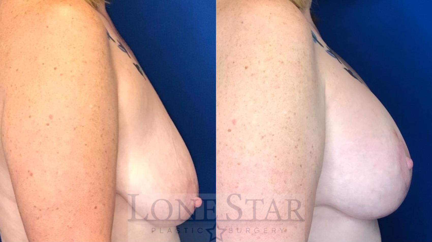 Before & After Breast Lift Case 46 Left Side View in Frisco, TX