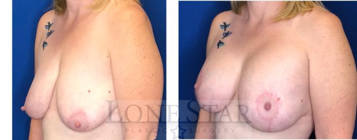Before & After Breast Augmentation with Lift Case 46 Right Side View in Frisco, TX