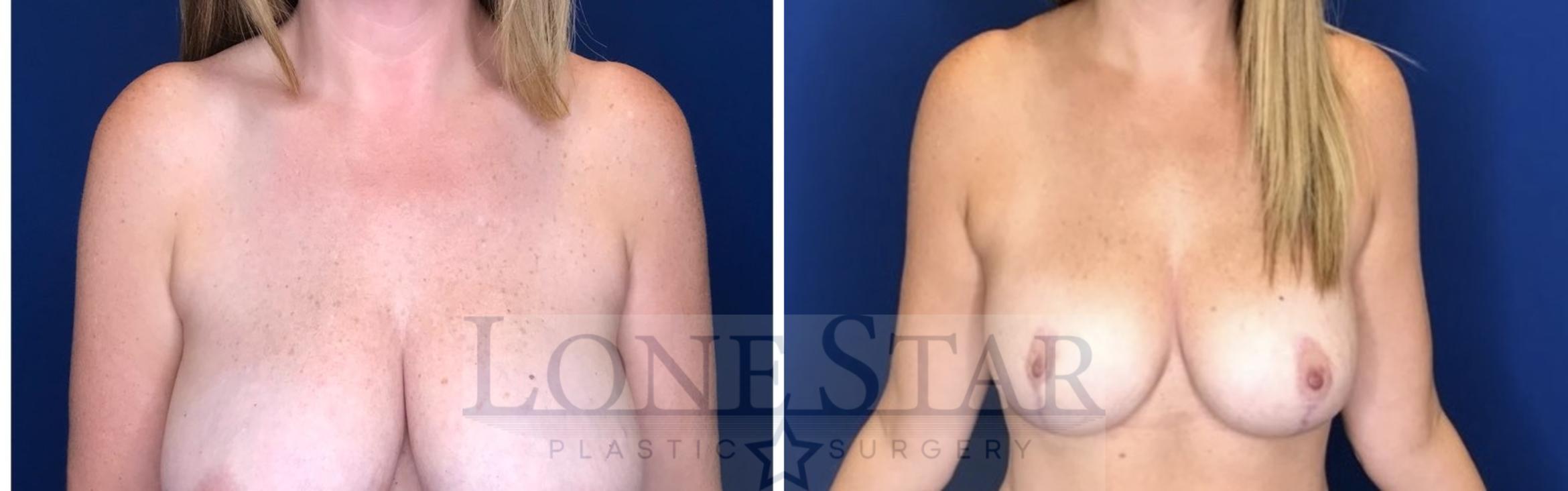 Before & After Breast Lift Case 55 Front View in Frisco, TX
