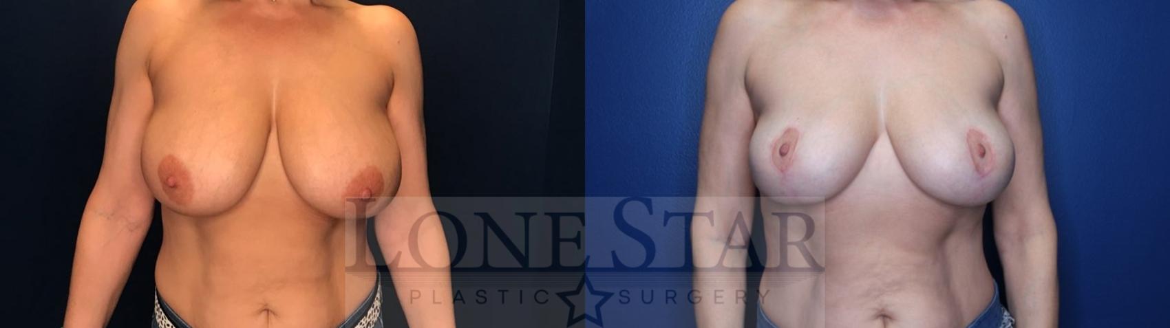 Before & After Breast Reduction Case 135 Front View in Frisco, TX