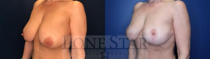 Before & After Breast Reduction Case 135 Left Oblique View in Frisco, TX