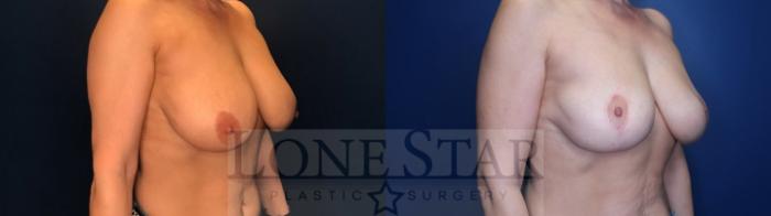 Before & After Breast Reduction Case 135 Right Oblique View in Frisco, TX