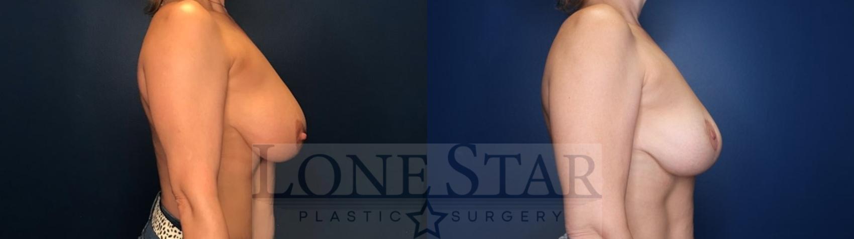 Before & After Breast Reduction Case 135 Right Side View in Frisco, TX