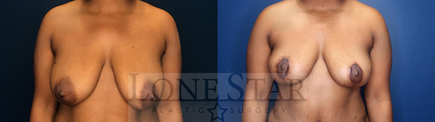 Before & After Breast Reduction Case 139 Front View in Frisco, TX