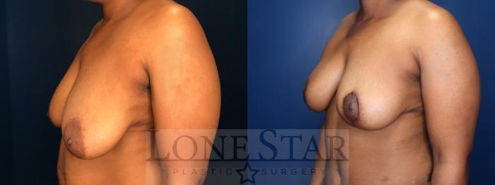 Before & After Breast Reduction Case 139 Left Oblique View in Frisco, TX