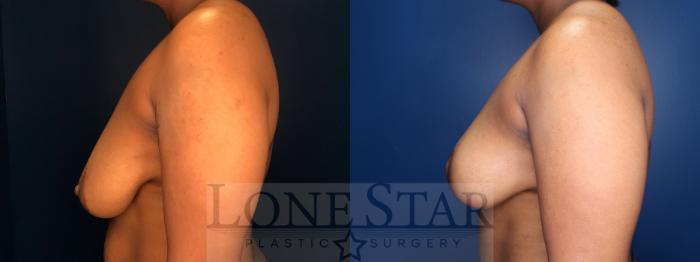 Before & After Breast Reduction Case 139 Left Side View in Frisco, TX