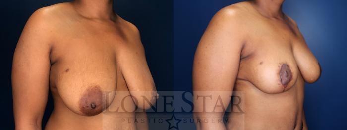 Before & After Breast Reduction Case 139 Right Oblique View in Frisco, TX