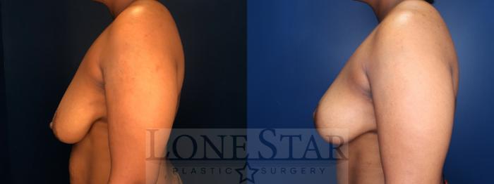 Before & After Breast Reduction Case 139 Right Side View in Frisco, TX