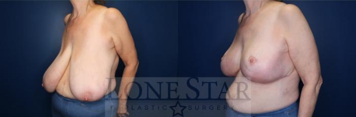 Before & After Breast Reduction Case 140 Left Oblique View in Frisco, TX