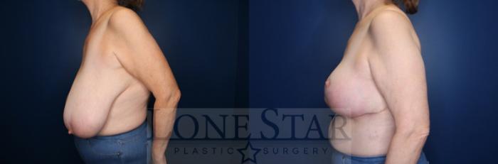 Before & After Breast Reduction Case 140 Left Side View in Frisco, TX