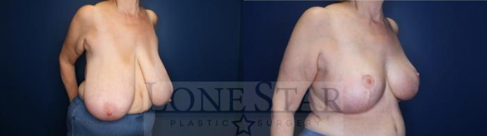 Before & After Breast Reduction Case 140 Right Oblique View in Frisco, TX