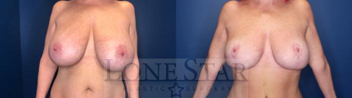 Before & After Breast Reduction Case 143 Front View in Frisco, TX