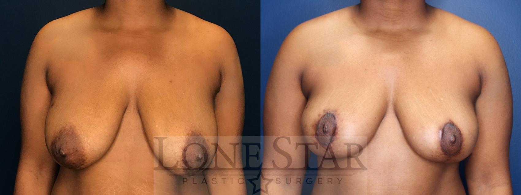 Before & After Breast Reduction Case 181 Front View in Frisco, TX