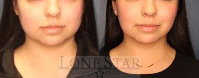 Before & After Facetite and Morpheus Case 192 Front View in Frisco, TX