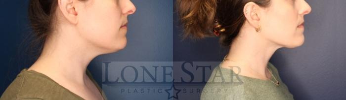 Before & After Chin Augmentation Case 201 Left Side View in Frisco, TX