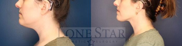 Before & After Chin Augmentation Case 201 Right Side View in Frisco, TX