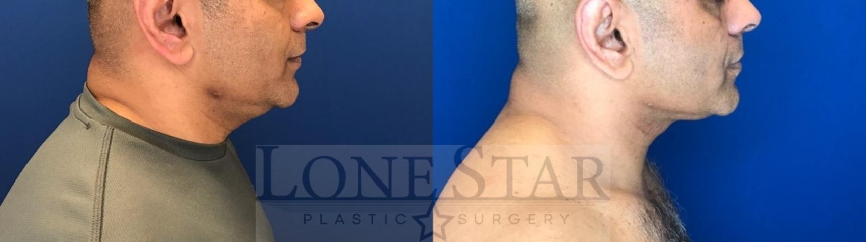 Before & After Embrace RF  Case 163 Right Side View in Frisco, TX