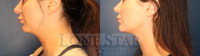 Before & After Embrace RF Facetite Case 162 Left Side View in Frisco, TX