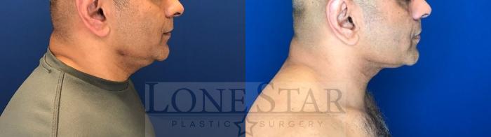 Before & After Embrace RF Facetite Case 163 Right Side View in Frisco, TX