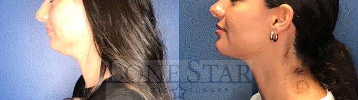 Before & After Embrace RF Facetite Case 165 Left Side View in Frisco, TX