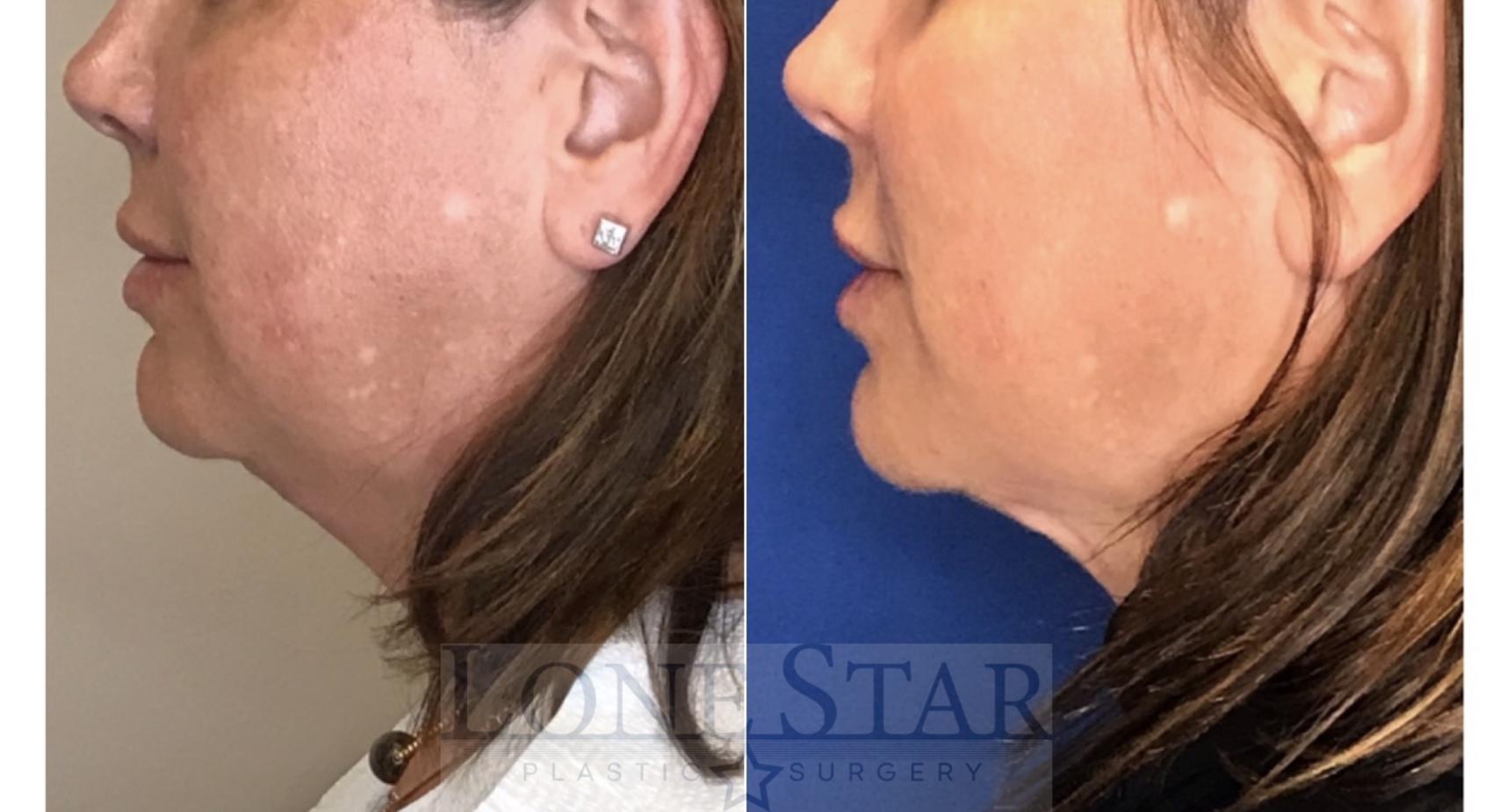 Before & After Embrace RF Facetite Case 39 View #1 View in Frisco, TX