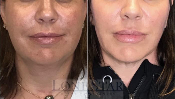 Before & After Embrace RF Facetite Case 39 View #2 View in Frisco, TX