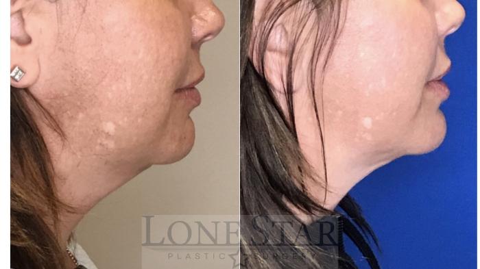 Before & After Embrace RF Facetite Case 39 View #3 View in Frisco, TX