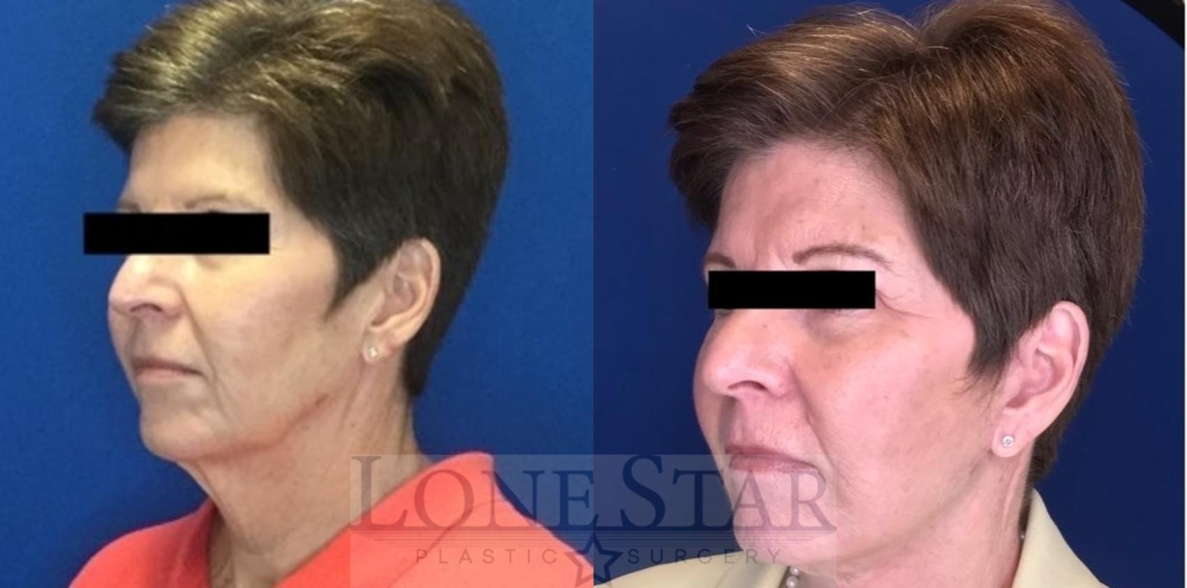 Before & After Facelift and Neck Lift Case 208 Left Oblique View in Frisco, TX