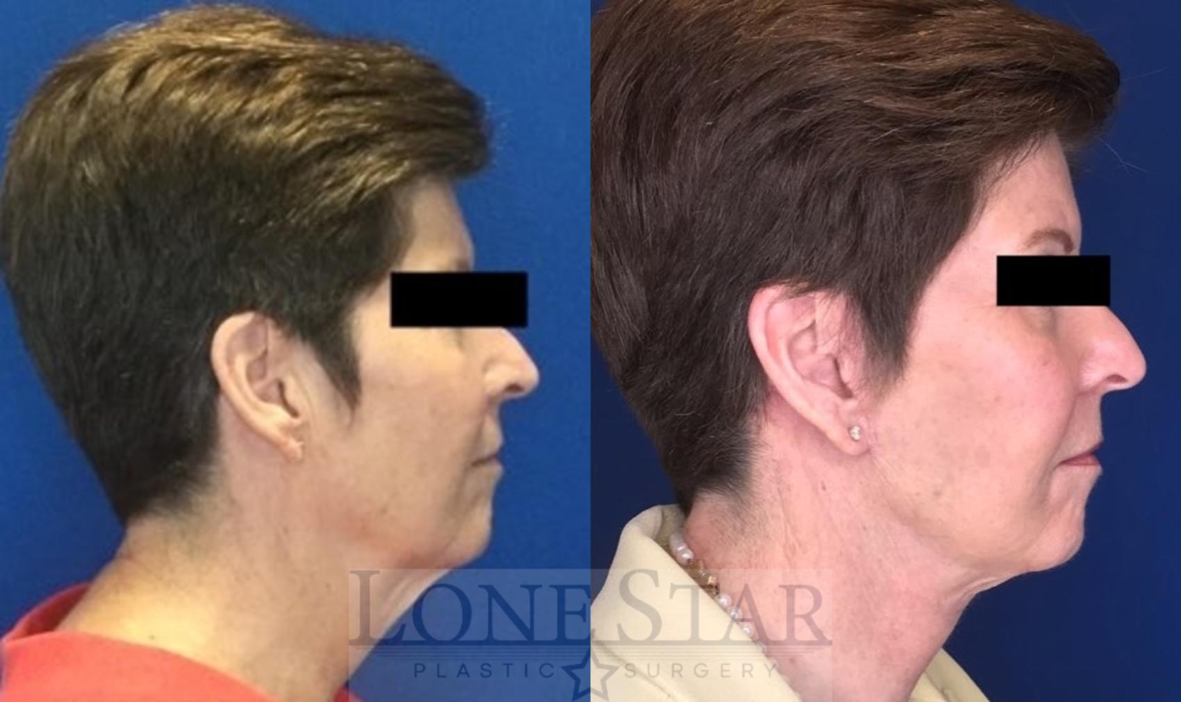 Before & After Facelift and Neck Lift Case 208 Right Side View in Frisco, TX