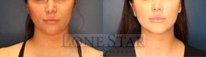 Before & After Facetite and Morpheus Case 162 Front View in Frisco, TX