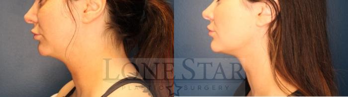 Before & After Facetite and Morpheus Case 162 Left Side View in Frisco, TX