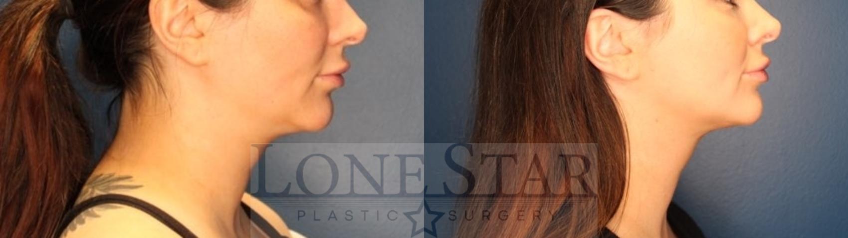 Before & After Facetite and Morpheus Case 162 Right Side View in Frisco, TX
