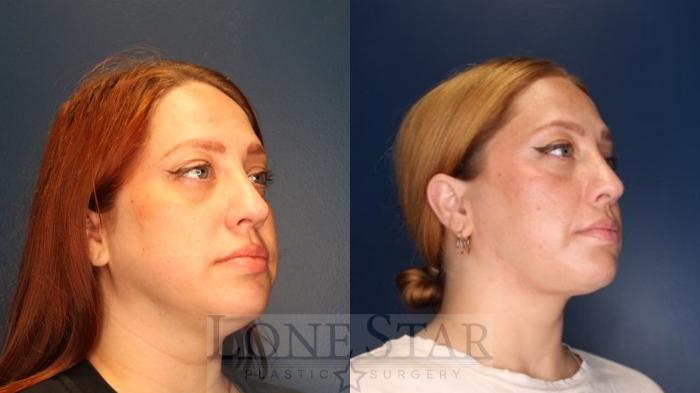 Before & After Jawline Contouring Case 189 Right Oblique View in Frisco, TX