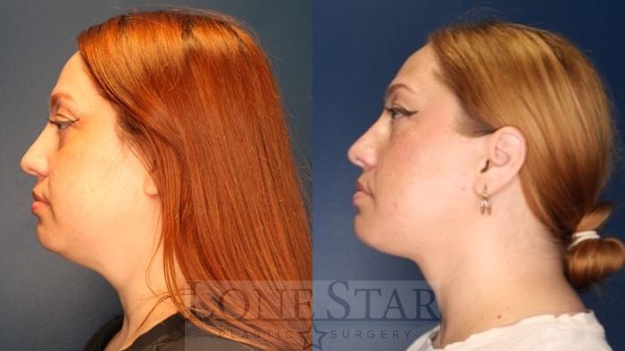 Before & After Jawline Contouring Case 189 Right Side View in Frisco, TX