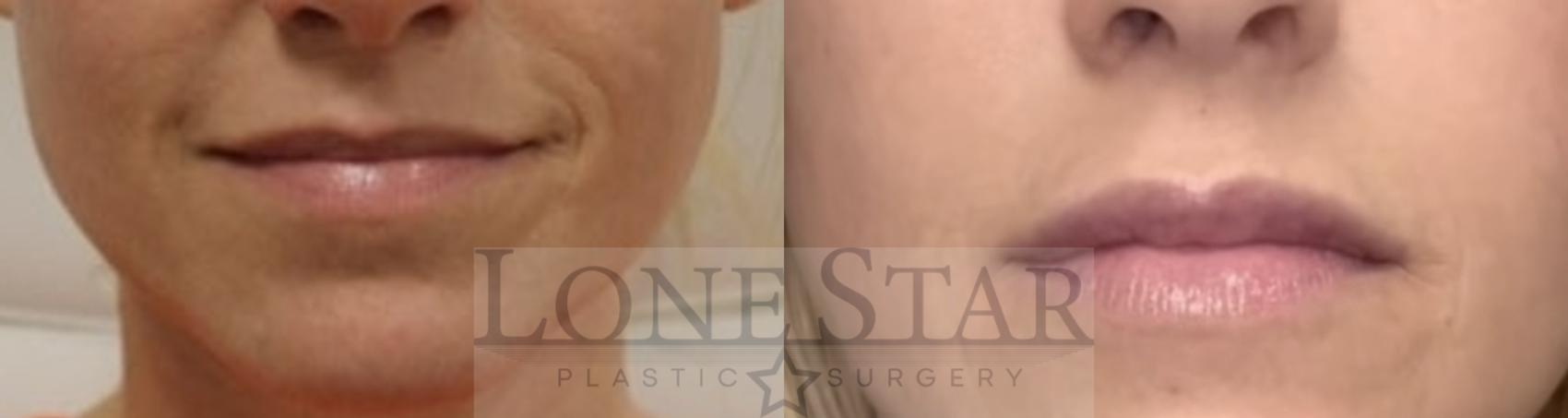 Before & After Juvéderm® Filler Case 198 Front View in Frisco, TX