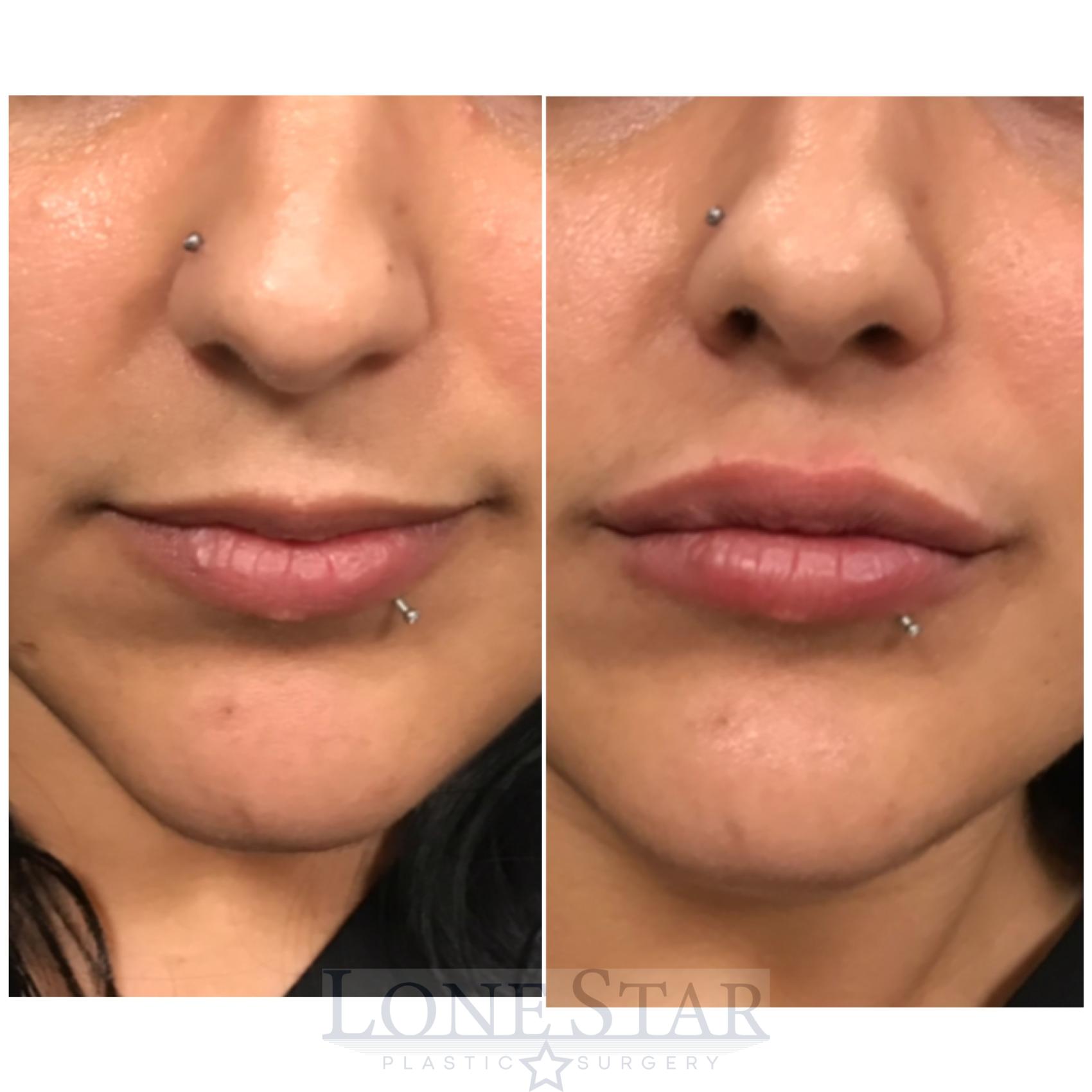 Before & After Lip Fillers Case 11 View #1 View in Frisco, TX