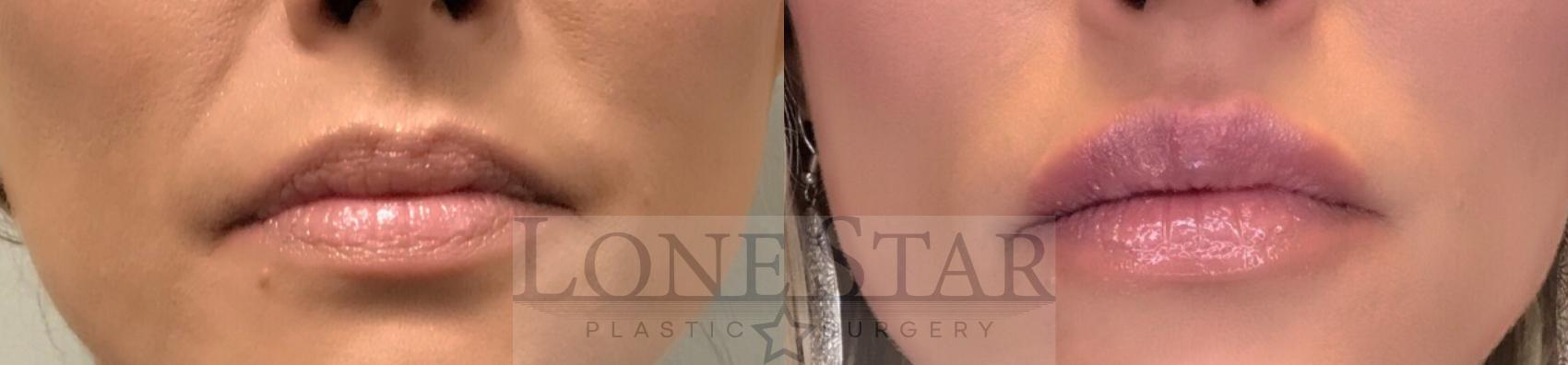 Before & After Lip Fillers Case 17 View #1 View in Frisco, TX