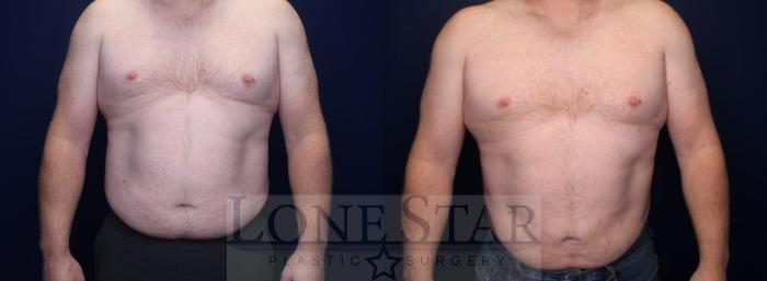 Before & After Liposuction Case 215 Front View in Frisco, TX