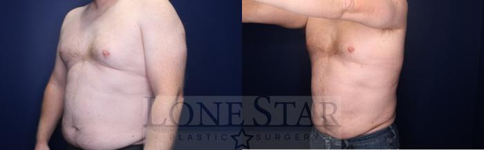 Before & After Liposuction Case 215 Left Oblique View in Frisco, TX