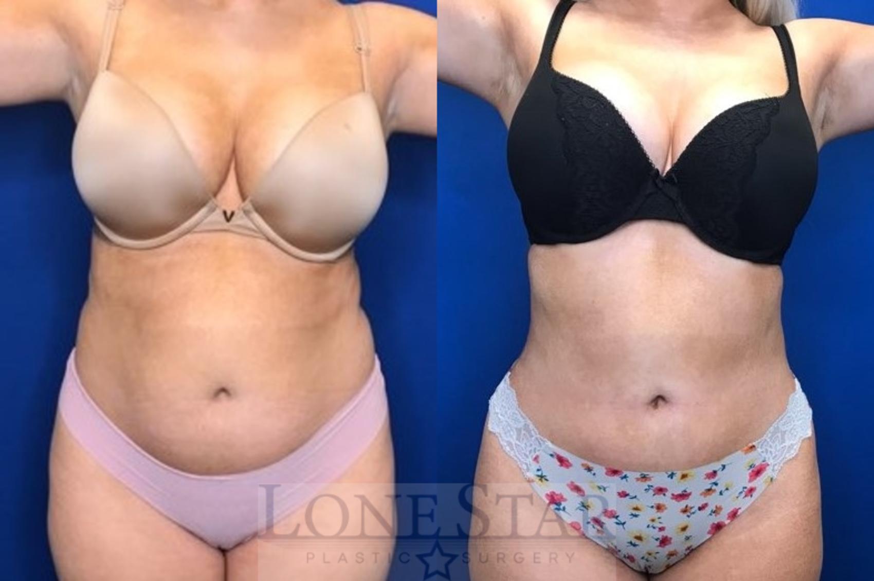 Before & After Liposuction Case 31 View #1 View in Frisco, TX