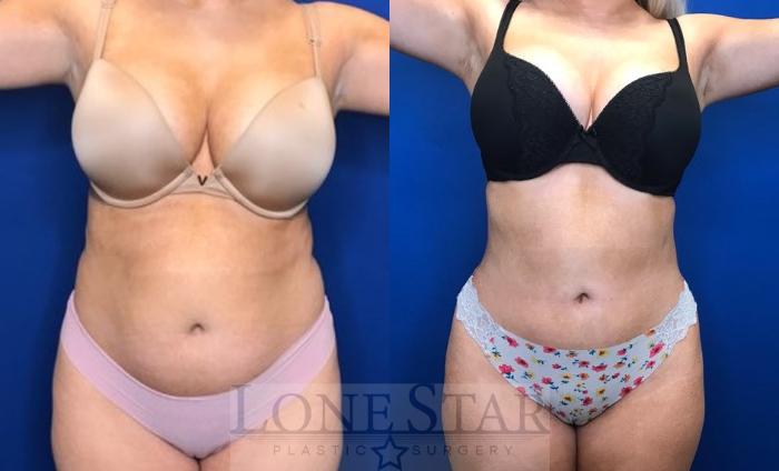 Before & After Liposuction Case 31 View #1 View in Frisco, TX