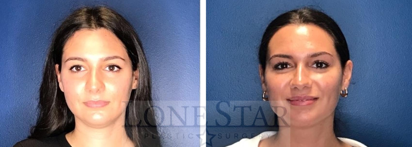 Before & After Liposuction Case 72 Front View in Frisco, TX