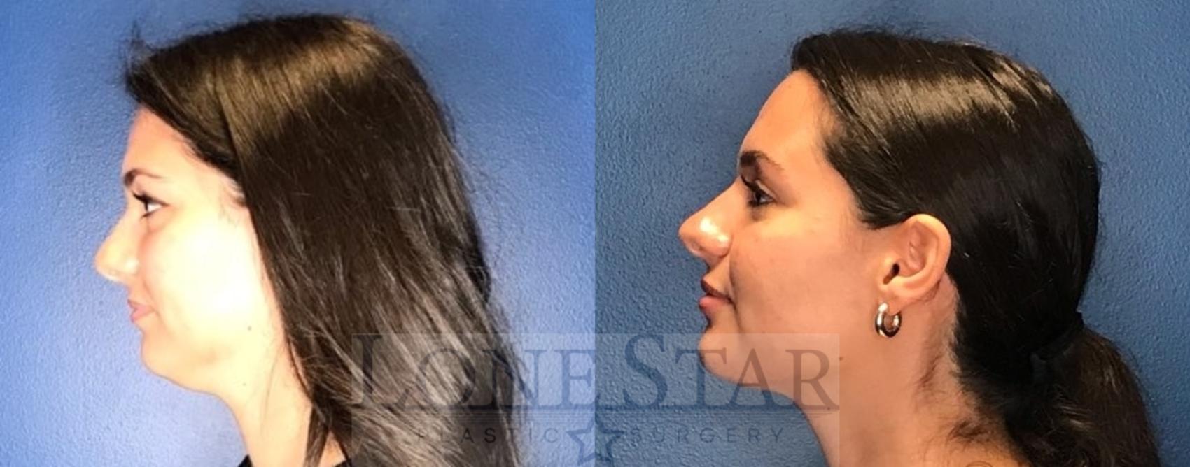 Before & After Liposuction Case 72 Left Side View in Frisco, TX