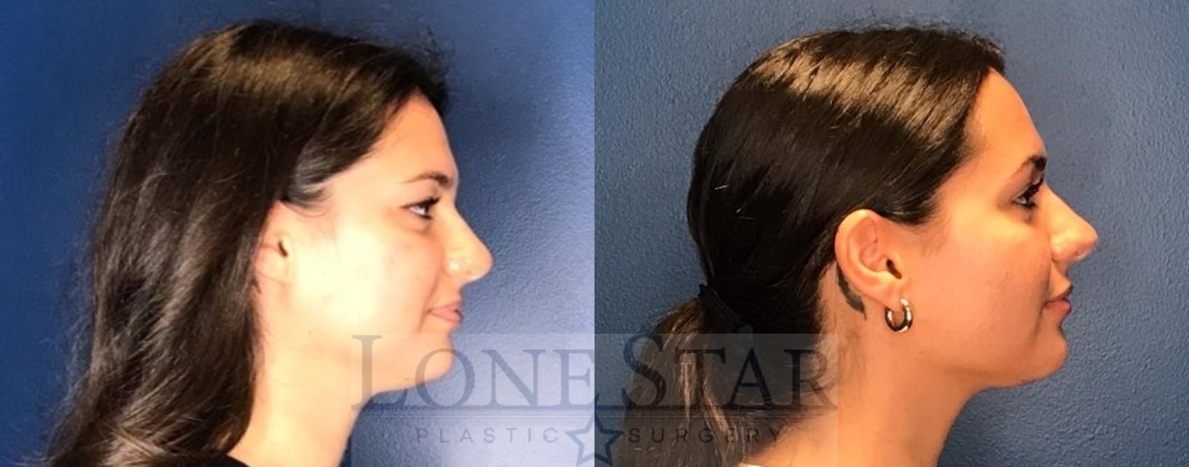 Before & After Liposuction Case 72 Right Side View in Frisco, TX