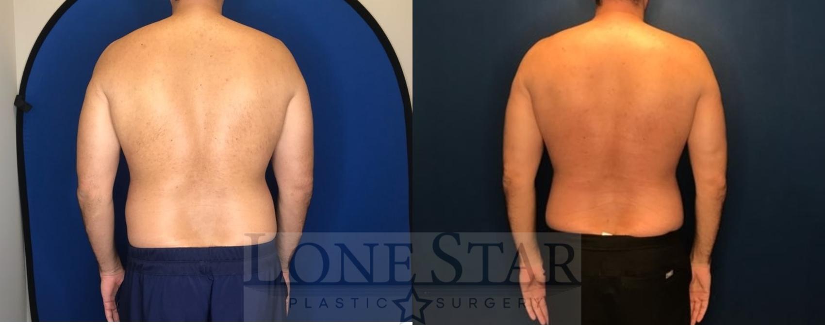 Before & After Liposuction Case 78 Back View in Frisco, TX
