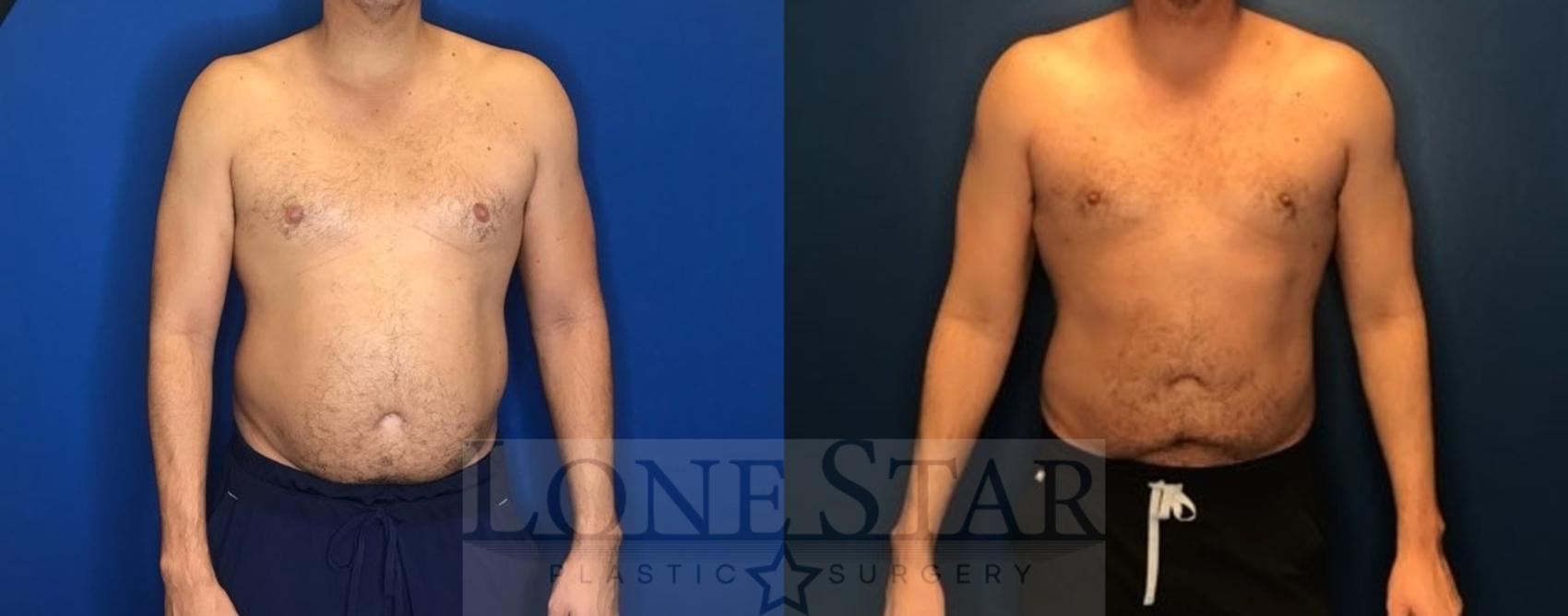Before & After Liposuction Case 78 Front View in Frisco, TX