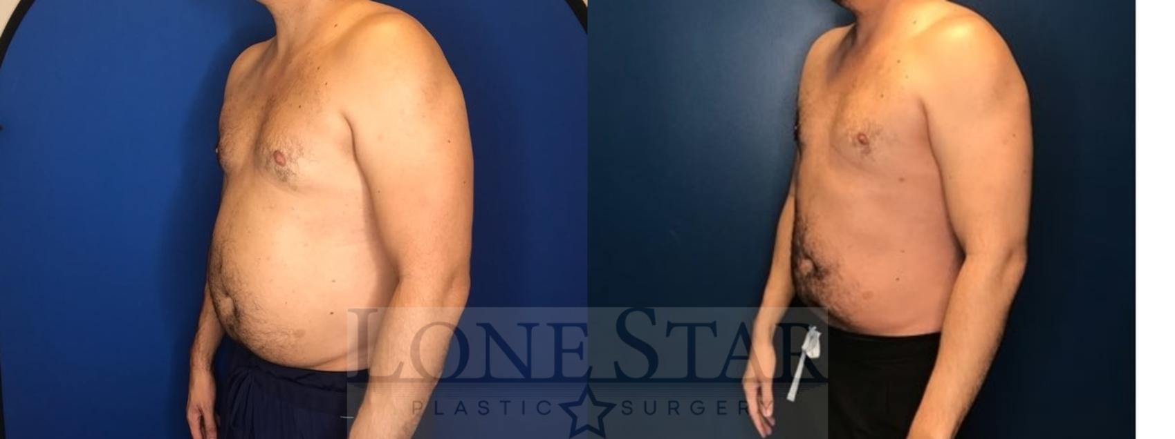 Before & After Liposuction Case 78 Left Oblique View in Frisco, TX