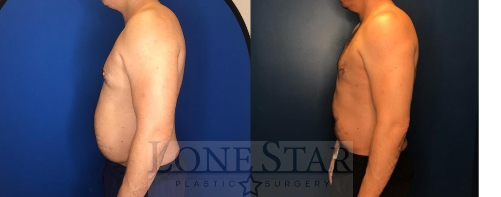 Before & After Liposuction Case 78 Left Side View in Frisco, TX