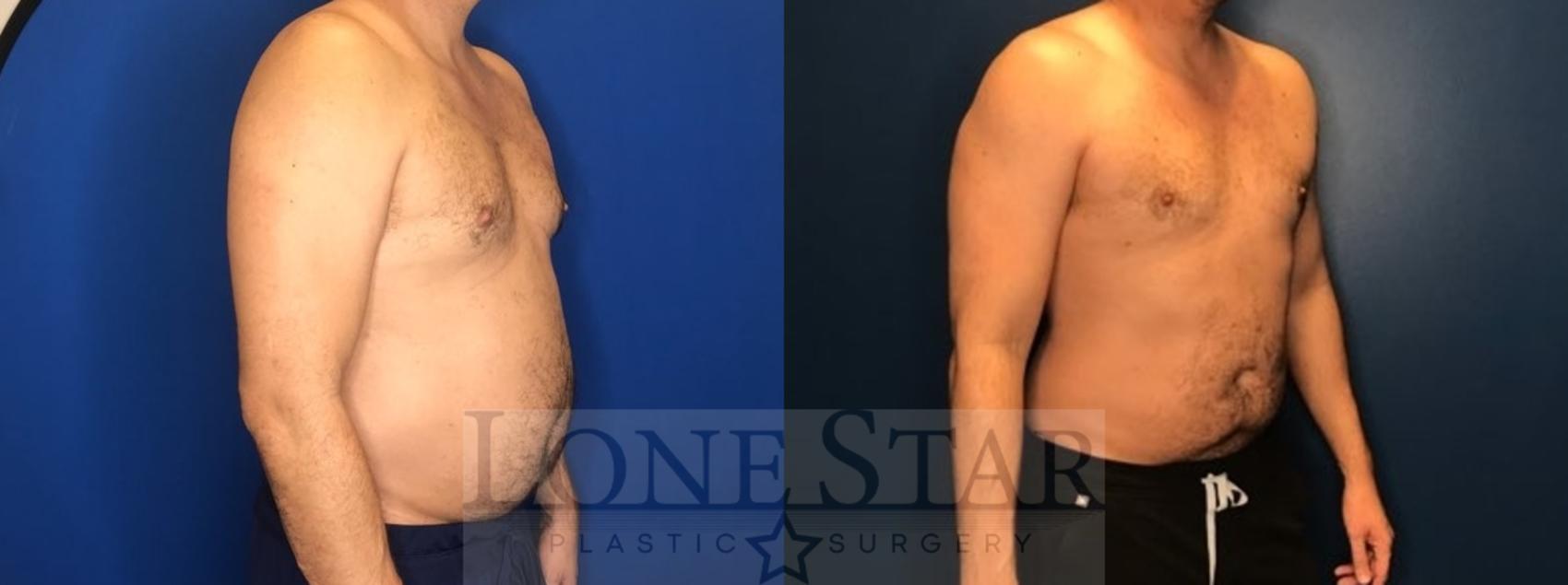 Before & After Liposuction Case 78 Right Oblique View in Frisco, TX